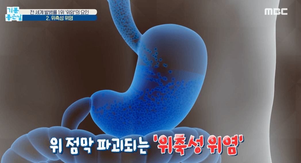 위에서 발생하는 악성종양
