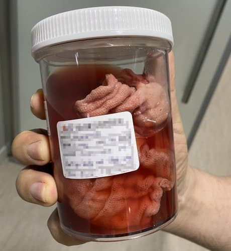 몸속에 거즈 남아있던 산모에게