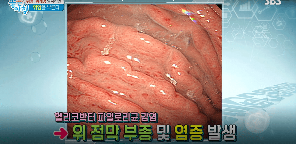 천공이 생기는 위궤양, "뚜렷한 초기 증상 없어"(+위궤양에 좋은 음식과 예방법)