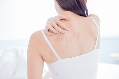 루푸스병, 여성 발생률이 높은 이유와 예방에 좋은 음식(+증상, 효능)