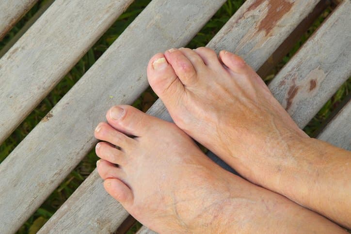 후천적 요인이 더 크다는 무지외반증, 증상 및 치료법