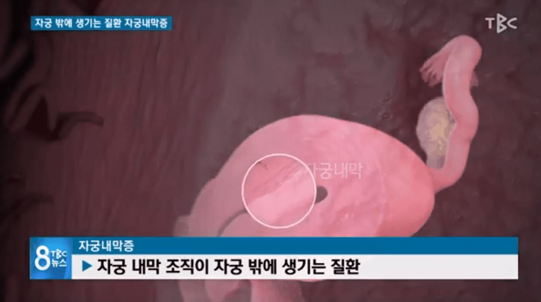 에스트로겐 수치 낮추면 자궁내막증 예방 가능하다?