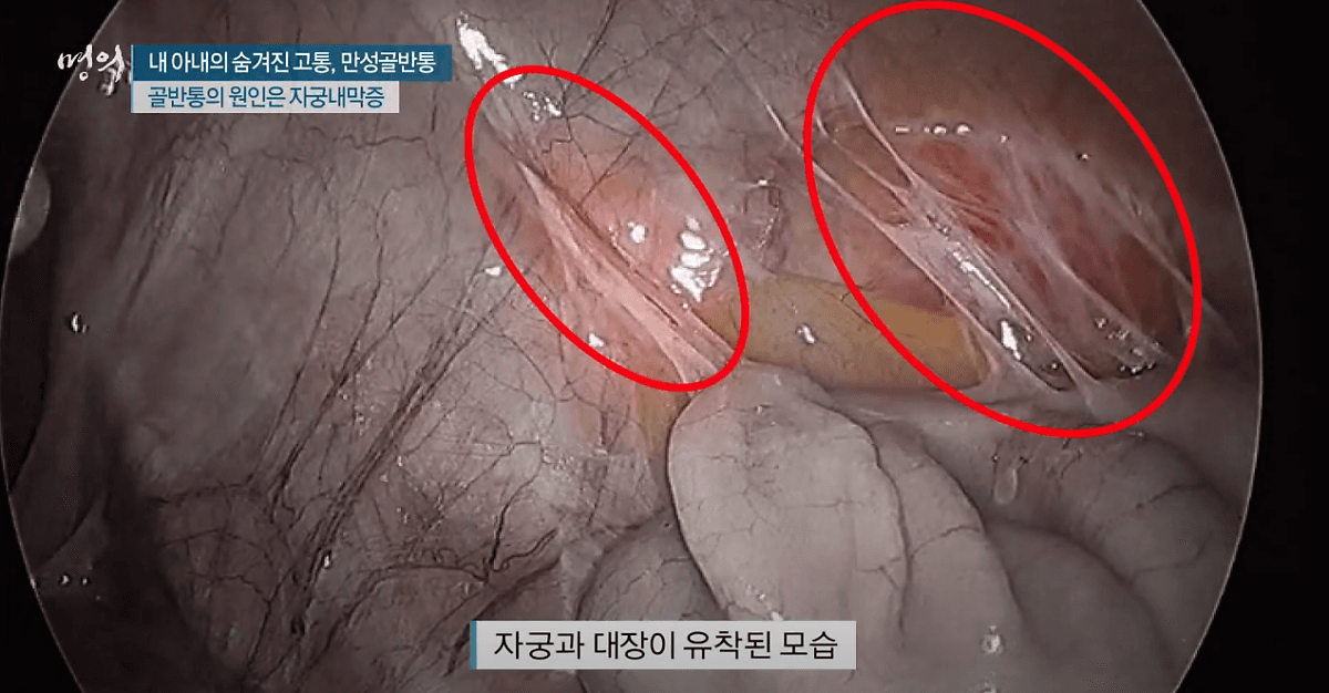 가임기 여성의 15%가 자궁내막증으로 고생한다