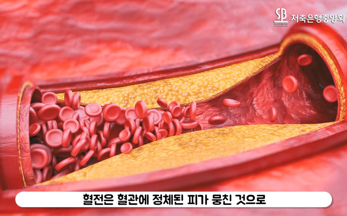 피임약 먹는 사람은 혈전 걸리기가 쉽다?