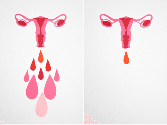 생리 불규칙 야기하는 ‘다낭성난소증후군’, 증상 및 예방법